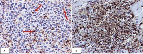 Figure 4. Immunohistochemical localisation of CD3+ immune cells in Colon-26 tumours. On the eighth day of growth, mock-transfected Colon-26 tumour contained a number of CD3 positive immune cells (red arrows) in close proximity to viable tumour cells (blue nuclei) (A). In contrast, after eight days, the site of inoculation with the sgrp170 transfected tumour cells consists of a dense aggregation of CD3 positive immune cells and few viable tumour cells. (20 × original magnification) (B).