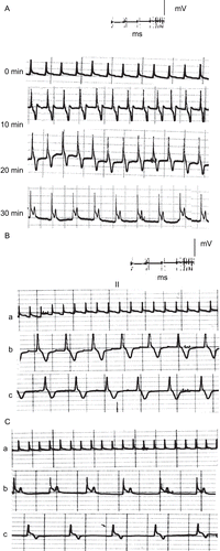 Figure 5.  ECG traces showing (A) the effect of direct perfusion of isolated toad heart with butanol extract solution (0.2 μg/mL) of C. procera on the electrocardiogram of isolated toad heart at different time intervals; (B) the effect of adding atropine (4 μg/mL) after butanol extract application, and (C) the effect of adding verapamil (5 μg/mL) after butanol extract application (a) before treatment, (b) 20 min after treatment, (c) after adding blocker.