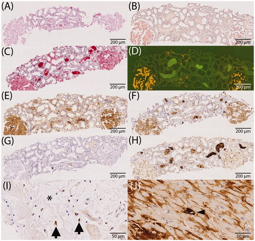 Figure 1. Immunostaining of apolipoprotein E, caspase 3, complement 3 and 9 in relation to amyloid (study cohort). (A–H) Comparison between immunohistochemistry and the enrichment of investigated proteins using the example of renal ALκ amyloidosis. Serial sections: hematoxylin eosin staining (A), Congo red staining in bright light (B), immunostaining with antibodies directed against κ-light chain (C), Congo red staining in fluorescence light (D; same section as in B), immunostaining with antibodies directed against apolipoprotein E (E), complement 9 (F), caspase 3 (G) and complement 3 (H); (I) caspase 3 immunoreactive cardiomyocytes (arrows) within amyloid deposits (asterisk). (J) Complement 9 immunoreactive cardiomyocytes (arrow head) surrounded by complement 9 immunoreactive amyloid deposits. Hematoxylin counterstain.