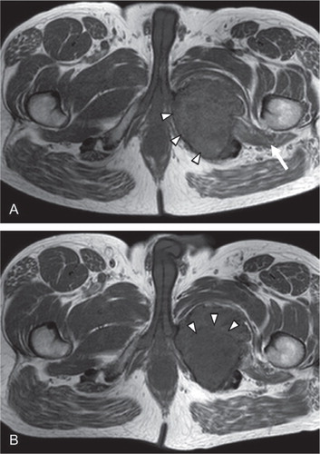 Figure 2. A. T1-weighted MR imaging before treatment with denosumab showed a highly vascularized lesion (arrowheads) extending into the surrounding soft tissues (arrow), consistent with GCTB. B. T1-weighted MR imaging 3 months after the start of denosumab treatment showed that there was no progression of disease. Areas of central necrosis were seen (arrowheads).