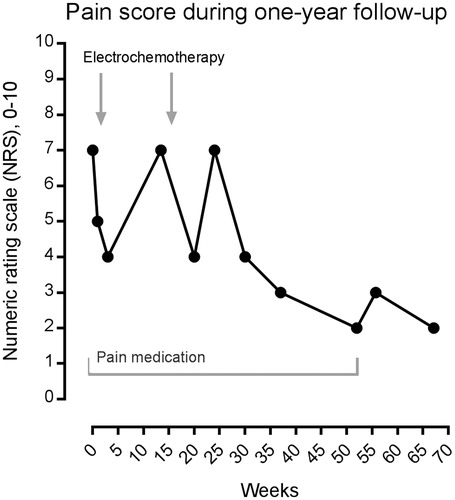 Figure 3. Pain score using the NRS scale, and use of pain medication. Using the numeric rating scale (NRS), from 0 (no pain) to 10 (worst imaginable pain), the patient was asked to describe pain before, during and after electrochemotherapy. Initially, the patient was taking pain medication (gabapentin, tramadol), and continued to do so until her pain score was down to 2, after which this was discontinued (period of pain medication shown on graph). In conclusion, the NRS pain score went from 7 with gabapentin and tramadol to 2 without pain medication after electrochemotherapy.