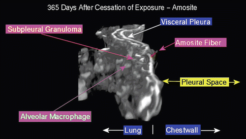 Figure 19.  View of the pleural space from an animal exposed to amosite asbestos at 365 days postexposure. An amosite fiber penetrating the visceral pleural wall into the pleural space is seen. On the lung side, a well-developed subpleural granuloma is seen with alveolar macrophages on the surface.