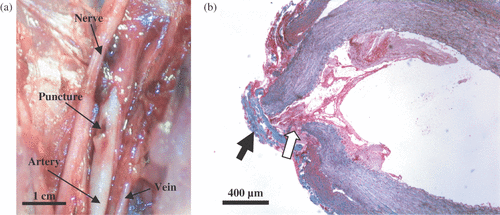 Figure 2. Gross (a) and light microscopy (b) observations of a HIFU-sealed puncture site in the femoral artery. The puncture was sealed by coagulated blood (white arrow) and a fibrous cap (black arrow). The histological slide was stained with Masson's trichrome stain.