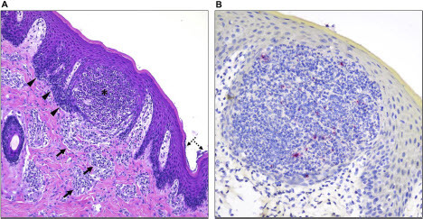 Figure 6. Histological alterations in the skin and immunohistochemical detection of MPXV antigen in one of the infected pigs. (A) Histologic alterations are characterized by epidermal pustule formation (*), hyperplasia of the adjacent epidermis (arrowheads) and superficial perivascular lymphohistiocytic and eosinophilic dermatitis (arrows). The corneal layer of the epidermis was occasionally colonized by coccoid bacteria (dashed arrows). (B) Within this single pustule, sporadic degenerate inflammatory cells contain minimal intracytoplasmic viral antigen (red). No viral antigen was detected within keratinocytes or other cell types. H&E, 200X total magnification; Fast Red, 400X total magnification.