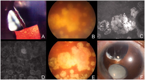 FIGURE 1. Clinical course of the case presented. (A) Granulomata along the peripheral iridectomy margin (RE) at the age of 24 years. (B) Disseminated chorioretinal punched-out patches (RE) at the age of 24 years. (A) + (B) raised the suspicion of ocular tuberculosis. (C, D) The infrared and fluorescein angiography images disclosed punched-out scars without active leakage (RE). (E) Considerably clearer vitreous opacity with dry chorioretinal scars after 18 months of anti-tubercular treatment at the age of 30 years (RE). (F) Corectopia with anterior capsule fibrosis at the age of 30 years (RE).