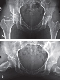 Figure 1. Plain AP (A) and lateral view (B) showing a normal alpha angle. A 12 × 14 mm calcified irregular-shaped image was seen at the superolateral acetabular rim. Excluding the “os acetabuli”, the center-edge angle was 15º (25º in the contralateral hip). The Tönnis angle was 24º.