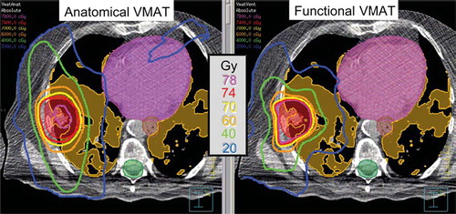 Figure 4. Example isodose distributions of anatomical and functional VMAT plans. Functional VMAT spared the highly-functional lung, and anatomical VMAT treated the lungs as uniformly functional. Highly-functional lung regions are shaded orange; PTV red; spinal cord planning organ-at-risk volume (PRV) green; oesophagus PRV brown and heart pink.