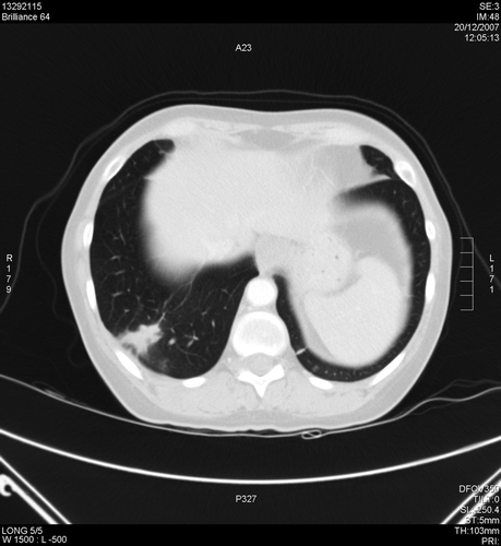 Figure 1.  Chest CT scan of the thorax 1 month prior to sunitinib discontinuation after 16 cycles of treatment (20-12-2007).