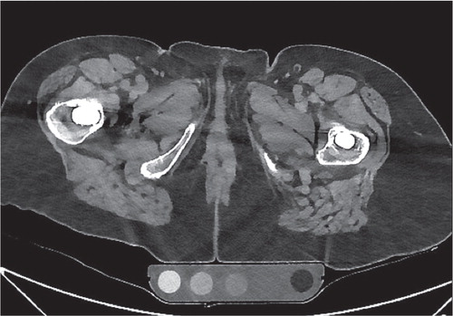 Figure 2. Images in current clinical practice at the same location. Axial CT image, 256-slice CT scanner, soft tissue window width and window level (40 400). Model-based iterative reconstruction with O-MAR at level of the prosthetic stem post-processing techniques are applied.
