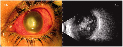 Figure 1. (A) Clinical photograph of the left eye showing corneal ulcer with hypopyon. (B) Ultrasound of the left eye showing significant vitreous echoes with attached retina.