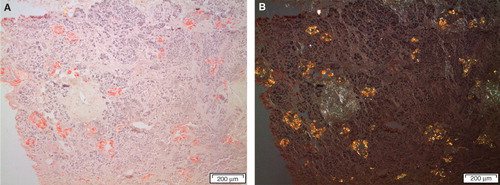 Figure 5. Section from the pancreas of a diabetic subject with severe islet infiltration of amyloid in all islets, visualized with Congo red. The section in A is seen in ordinary light, while in B polarized light with crossed polars has been used. A bright yellow birefringence is evident.