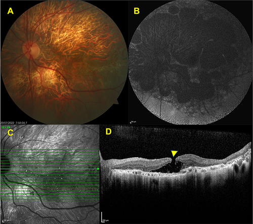 Figure 7 Associated macular hole. Left eye, color fundus image (A) delineating the extensive chorioretinal atrophy and choroidal sclerosis. FAF image (B) revealing the multiple hypofluorescent patches corresponding to the posterior pole. SD-OCT section showing the presence of full -thickness hole (yellow arrow) (C,D).