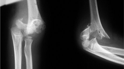 Figure 5. A child with a type-III supracondylar fracture of the humerus.