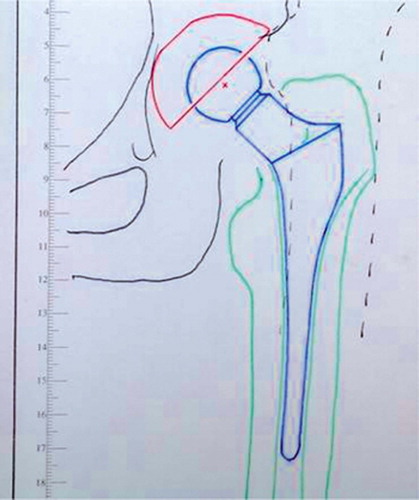 Figure 4. The design of the custom prosthesis from the surgeon.