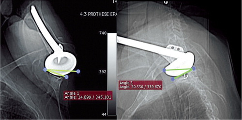 Figure 3. Coronal and sagittal scout views of the shoulder with the most severely limited active flexion angle of the series and also indicating the angle (non-ideal alignment) between the glenoid orientation and the CT-scan acquisition plane.