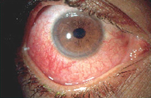 Figure 5. Red eye as a result of uveitis.