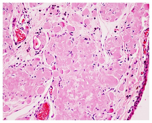 Figure 1 Amyloid deposition appearing as an amorphous, eosinophilic extracellular substance in the stroma of a subepithelial area of the eyelid.