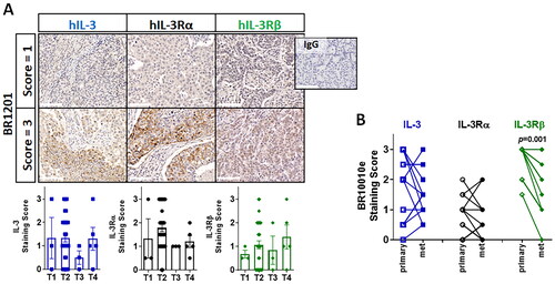 Figure 2. Human TNBC TMAs – IL-3/IL-3R IHC scores –T1-T4, primary and metastases.(A) Representative IHC of IL-3, IL-3Rα and IL-3Rβ protein expression by human TNBC TMA (#BR1201) across patients grouped in T1-4. DAB staining (brown) and hematoxylin counterstain (blue). Staining intensity scored for IL-3 (blue), IL-3Rα (black) or IL-3Rβ (green) with results shown as scores averaged from two cores for each of the 43 different tumor samples (T1 n = 3, T2 n = 32, T3 n = 3, T4 n = 5) mean ± sem with statistical analysis using one way ANOVA with multiple comparisons and p < 0.05 considered significant. White scale bar = 100µm. (B) TMA (#BR1001e) staining intensity scored for IL-3 (blue), IL-3Rα (black) or IL-3Rβ (green) for patient matched primary (open symbols) or metastasis sections (closed symbols). Results shown as scores averaged from two cores for each of the 12 different patient samples that are linked by a solid line from the patient primary to metastatic tumor. A paired t-test was performed for the patient matched primary and metastatic lesions with p < 0.05 considered significant.