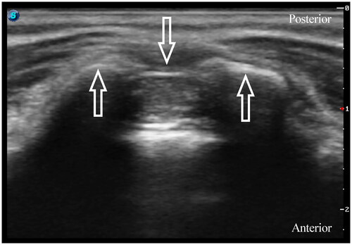 Figure 2. A transverse ultrasound image of the sacral hiatus between the two sacral cornua (upward arrow). The downward arrow indicates the sacrococcygeal ligament.