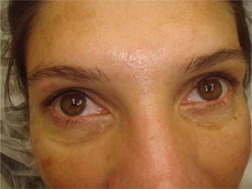 Figure 3B Monopolar radiofrequency treatment of lower eyelids after two treatments every other week.