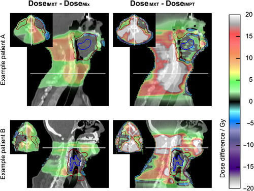 Figure 1. Dose differences overlaid on a sagittal and axial CT slice (slice positions are indicated by white lines) between pure IMXT plan and mixed modality treatment plan (left column) as well as between pure IMXT treatment and pure IMPT treatment (right column) for two exemplary patients with primary tumor site in the oropharynx (upper row) and the hypopharynx (lower row). The elective target volume is depicted in dark red and the gross tumor volume (GTV) in blue. Dose differences are small in the sequential boost volume consisting of GTV and involved lymph nodes (not depicted), increasing in the part of the elective volume in which no sequential boost is applied (right neck in patient A, left neck in patient B) and largest in the normal tissue surrounding the elective volume.