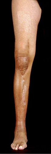 Figure 3. The lower-right leg with good soft tissue coverage by muscle flaps and skin graft.The skin alterations are due to radiation therapy.