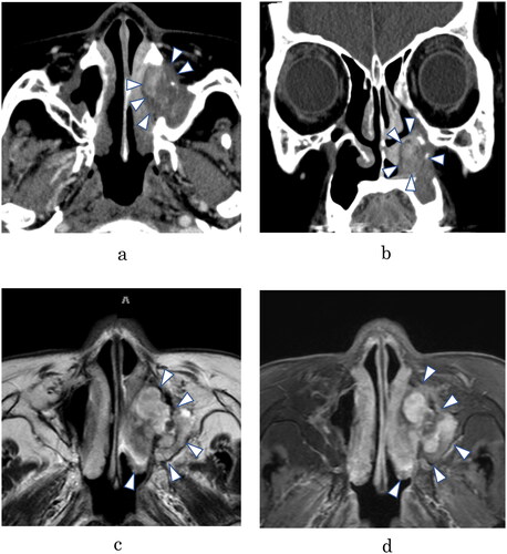 Figure 1. (A) Axial contrast enhanced (CE) computed tomographic (CT) scan, showing opacification of the inferior meatus, partly enhanced. (B) Coronal CE-CT scan. It is difficult to evaluate bone erosion or bone destruction accurately, but neither is apparent. (C) T2-weighted axial magnetic resonance imaging (MRI), showing a heterogeneous high-intensity signal in the same area as on the CT scan. (D) T1-weighted MRI with gadolinium, showing heterogeneous enhancement of the lesion.