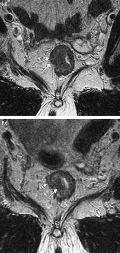 Figure 4.  Oblique axial T2 weighted MRI through rectal tumour (a) before and (b) after short course radiotherapy. (a) Tumour invasion was thought to be just through the muscle layer (stage T3) with loss of normal low signal muscle wall (arrows). (b) Following short course radiotherapy the low signal inner and outer muscle layers (arrows) are now visible (stage T2 on MR but T1 on histology), suggesting downstaging.