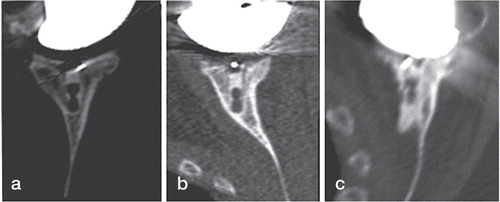 Figure 4. Axial CT views passing through the middle of the glenoid of 3 implants. On the left is shown the implant keel centrally positioned into the glenoid vault (a). In the middle is shown contact between the glenoid keel and the anterior glenoid wall (b). On the right is shown the glenoid keel perforating the anterior glenoid wall (c).