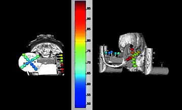 Figure 4. Graphical representation of Target Registration Errors (TREs). Shown are 3D reconstructions of the skull and target system from the CT scans. The surgical targets are colored according to error (blue=least error, red=most error; a numerical scale corresponding to colors is shown at right). The left panel presents the horizontal disc best, while the right panel presents the vertical disc best.