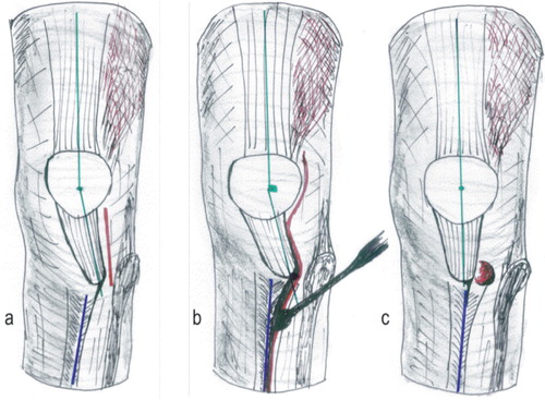 Figure 2. Schematic drawing of left knee. a. Following arthroscopy, a lateral incision was made starting at the mid-patellar level and extending distally to include the anterolateral arthroscopy portal to reach 1 cm below the tibial tuberosity. b. and c. In cases with concomitant osteochondral fragments, the incision was extended proximally allowing access to the lateral femoral condyle or the patella facet (red). Starting at the tibial tuberosity, the periosteum was split along the tibial crest for 6–8 cm distally without opening the fascia of the tibialis anterior muscle (red). The periosteum was subsequently detached from the tibial crest with a large rasp (blue). In knee flexion, the patella tendon then slides spontaneously medially to track within the femoral groove. Patella alignment was restored (green).