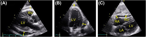 Figure 1. Echocardiography with pericardial effusion. A: parasternal long axis view. B: apical four-chamber view. C: subcostal view. Double arrows indicate the measure points of pericardial effusion. LV, left ventricle; RV, right ventricle; LA, left atrium; RA, right atrium.