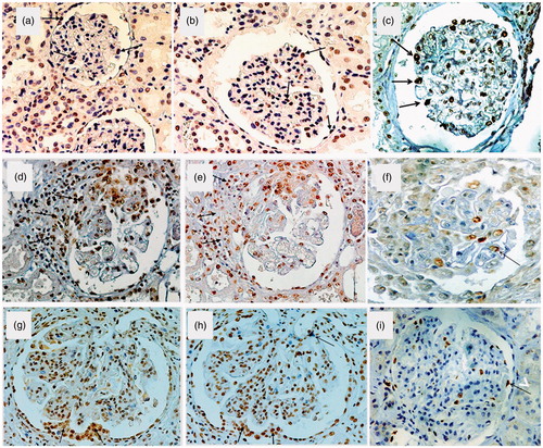 Figure 1. Expression pSmad2/3, p300 and p57 in normal human kidney: A few glomerular cells, including all cell types, were pSmad2/3 positive (a) (arrows). Less than 30% of glomerular cells, including all cell types, were p300 positive (b). Podocyte staining for p57 in the normal kidney was abundant with a nuclear staining pattern (c). Immunopositivity for psmad2/3 and p300 (d, e,) but not for p57 (f) in a cellular crescent (arrows) (Wegener granulomatosis). Immunopositivity for psmad2/3 and p300 (g, h) but not for p57 (i) in hyperplastic lesions and microadhesions (arrows) (proliferative lupus nephritis, WHO class IV). (Figure 1a, b, d, e, g and h are reproduced from Kassimatis et al.Citation35). Original magnification ×400.