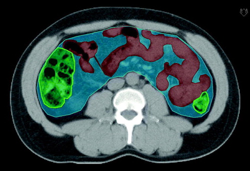 Figure 1.  Delineated bowel volumes: 1) Small bowel (red structure), 2) Large bowel (green), and 3) “Whole abdomen” (blue).
