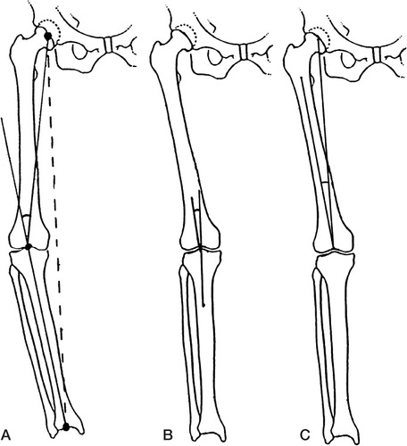 Figure 1. Schematic pictures showing the methods for radiographic assessment of mechanical axis (A), tibiofemoral angle (B), and femoral angle (C).
