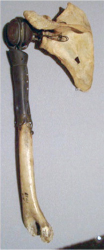 Figure 3. The first known shoulder arthroplasty developed and implanted by Jules Émile Péan in 1893. It is made of a platinum tube and fixated with use of screw holes at the distal end. The proximal ball consists of rubber, hardened by boiling in paraffin. The arthroplasty is on display in the Smithsonian Institute in Washington D.C., USA (Reprinted with permission from the American Journal of Roentgenology).