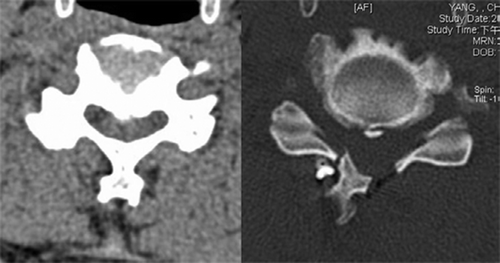 Figure 2. Comparison of postoperative and postoperative axial CT scans revealed widening of the spinal canal after unilateral open-door laminoplasty using suture anchor fixation.