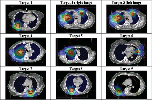 Figure 1. IMPT plans on targets 1–9 studied in this work on the midventilation phase of a 4DCT study. The doses 10 to 110% of the prescription is displayed in dose colour-wash.
