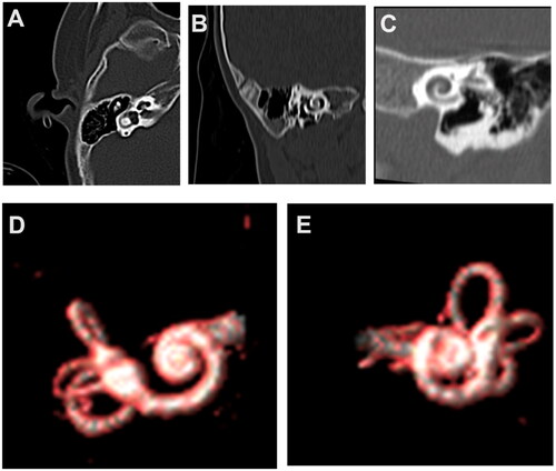 Figure 2. Tomography (TC) and magnetic resonance imaging (MRI) without alterations. (A) CT Axial reconstruction of the cochlea on the right side and lateral semicircular canal, with adequate diameter of the internal auditory canal (normal ear). (B) CT Axial reconstruction of the left side cochlea and lateral and superior semicircular canals (normal ear). (C) CT Axial reconstruction of the left side cochlea and lateral and superior semicircular canals (normal ear). (D) MRI reconstruction of the cochlea and semicircular canals in right ear. (E) MRI reconstruction of the cochlea and semicircular canals in left ear.