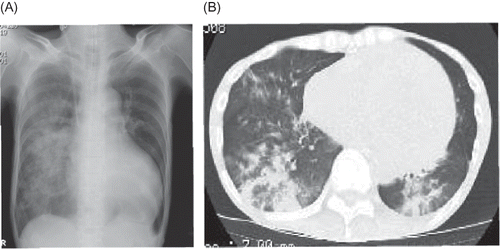 Figure 1. (A) Chest X-ray and (B) CT scan showing a severe, widespread infiltrate shadow of right lung.