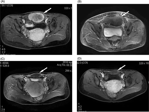 Figure 2. A 28-year-old woman with an abdominal wall desmoid tumour receiving no treatment before HIFU ablation. (A) Before HIFU ablation, the tumour (arrow) showed high enhancement on transverse T1-weighted contrast-enhanced MRI. (B) Four days after HIFU ablation, the treated area (arrow) showed no contrast enhancement, the skin overlying the treated area was swollen. (C) Ten months after HIFU ablation, no contrast enhancement was observed in the treated area (arrow), which shrank significantly. (D) Eighteen months after HIFU ablation, no enhancement was observed in the treated area (arrow), which shrank further.