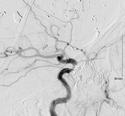 Figure 13 Cerebral angiogram showing ONYX embolization and endovascular coiling of pseudoaneurysm.