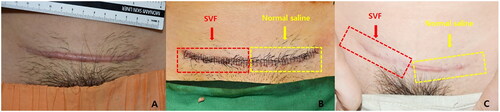 Figure 5. (A) Hypertrophic scar after Cesarean surgery 2 years prior. (B) Immediate postoperative image. The yellow section is the control side and the red section is the experimental treatment side. (C) Six months postoperatively. The scar appears less visible on the experimental treatment side than on the control side.