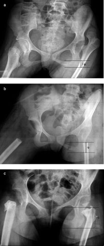 Patient number 7, a 14-year-old girl with quadriplegic cerebral palsy. She had severe pain, was unable to sit in her wheelchair, and had problems with perineal care. A. Radiograph showing left hip dislocation indicating the vertical distance (a) from the femoral resection level to the distal horizontal tangent of the os ischii. B. Radiograph 1 day postoperatively after bilateral PFRIA, showing the vertical distance (b) from the proximal femur to the distal horizontal tangent of the os ischii. C. Radiograph at 16 months, showing the vertical distance (c) from the proximal femur to the distal horizontal tangent of the os ischii and showing bilateral heterotopic ossification.