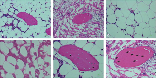Figure 1.  Histological features of osteonecrosis in rabbits. A. Nomal bone harvested from a comparable rabbit not treated with α-tocopherol nor treated with methylprednisolone acetate. B. Typical osteonecrotic lesion (experimental group). C. Nomal bone marrow cells. D. Necrotic bone marrow cells. Bone marrow cells had necrosis and stained acidophilic. The nuclei of bone marrow cells displayed pyknosis and karyorrhexis. The cellular structure of fat cells collapsed. E. Normal bone. Empty lacunae of the osteocytes (arrowhead) without bone marrow cell necrosis or fat cell necrosis. F. Osteonecrotic bone. Bone cells in the bone trabeculae showed pyknosis and empty lacunae (arrow) that were associated with necrotic changes of the surrounding bone marrow cells. Stain: hematoxylin and eosin; magnification: ×200 (A, B), ×400 (C, D, E, F).