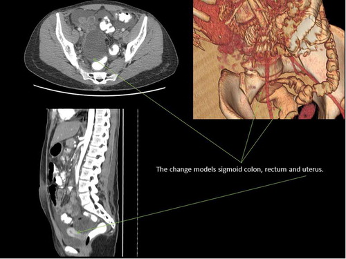 Figure 1.  Ovarian tumor models rectum, sigmoid colon, and uterus.