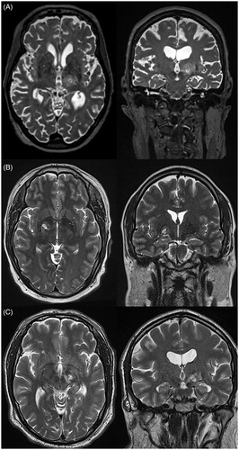 Figure 3. Axial (left) and coronal (right) T2-weighted MRIs demonstrating unilateral thalamotomy (A), pallidotomy (B), and subthalamotomy (C) using transcranial MRgFUS. MRI: magnetic resonance imaging; MRgFUS: magnetic resonance-guided focused ultrasound.