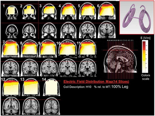 Figure 11. Colored field maps for the H10-coil indicating the absolute magnitude electrical field in each pixel at 100% of foot motor threshold, for 14 coronal slices 1 cm apart. Red pixels indicate regions with field intensity above the threshold for neuronal activation. Full color available online.