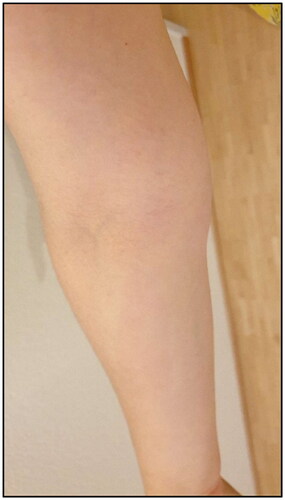Figure 1. Clinical presentation of red streak on the volar side of the forearm several days after second dose of Covid-19 vaccination.