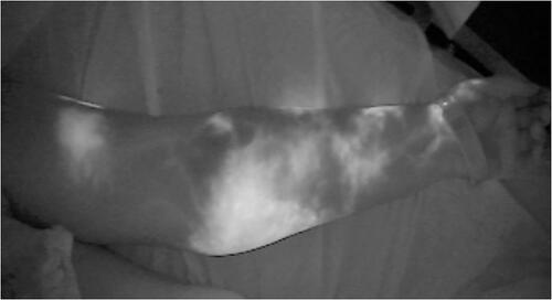 Figure 1. ICG lymphography showing dermal backflow, stardust pattern and diffuse lymphagiectasia, compatible with Yamamoto stage III/IV lymphedema.